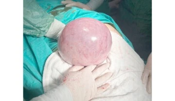 DEV TÜMÖR BAŞARIYLA ÇIKARILDI